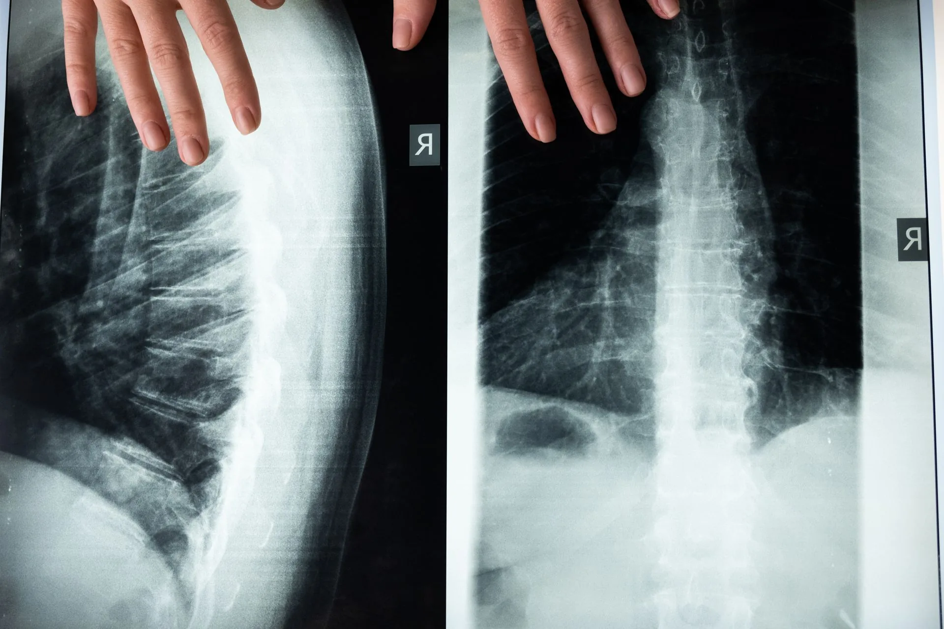 Hands resting on a light box showing side and front X-rays of the lumbar spine