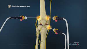 Illustration of the knee joint and the nerves around it