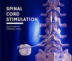 Illustration of a spinal cord stimulator lead placed along the spine
