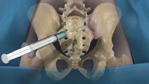 Illustration of the sacroiliac joint between the sacrum and pelvis