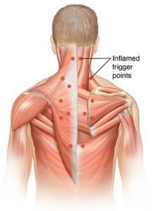 Illustration of trigger points in the upper back and shoulder muscles